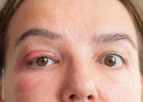 Close-Up of a Middle-Aged Woman with a Swollen Eyelid and Stye