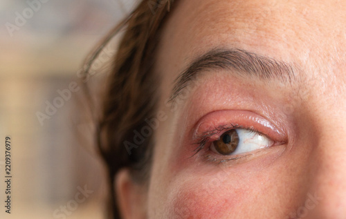 Close-Up of a Middle-Aged Woman with a Swollen Eyelid and Stye