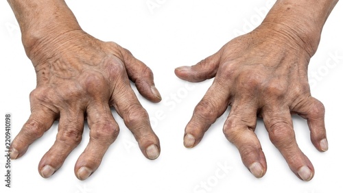 Close up of deformed arthritic hands with swollen finger joints and prominent knuckles showing advanced joint changes isolated on white background