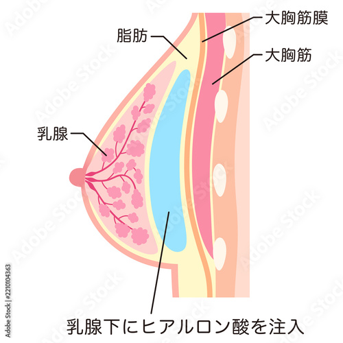 豊胸手術の構造　乳腺下にヒアルロン酸を注入した胸