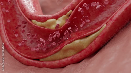 Cholesterol Plaque Buildup Narrowing Artery and Blocking Blood Flow 3D rendering