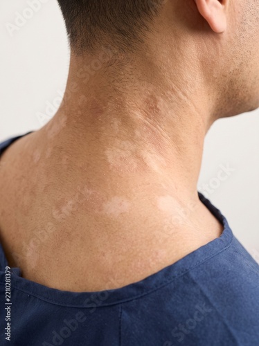 Tinea Versicolor on Neck with Hypopigmented Macules and Fine Superficial Scaling