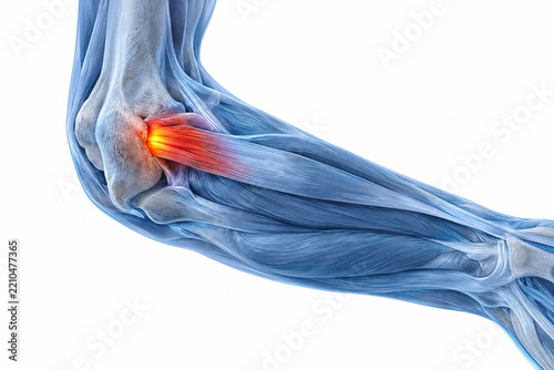 Close up view of human elbow joint anatomy with painful inflammation highlighted