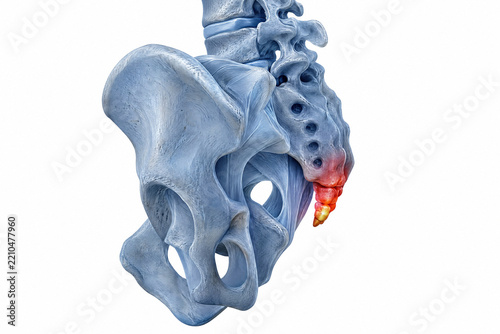 Human sacrum and coccyx bone anatomy showing tailbone injury and inflammation