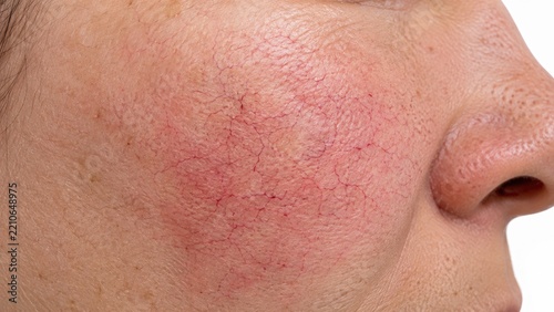 Close-up of facial cheek with visible spider veins, redness and superficial blood vessels on skin isolated on white background