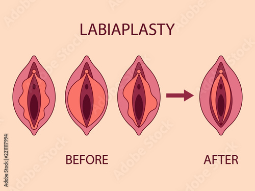 Labiaplasty Before and After Medical Illustration, Female Intimate Cosmetic Surgery Diagram