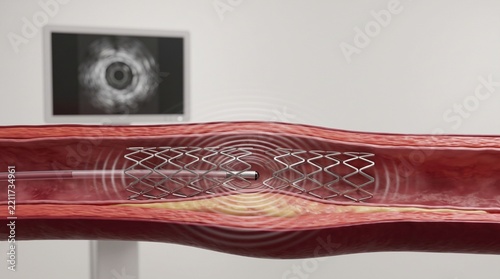 IVUS Guided Coronary Stent Assessment and Imaging