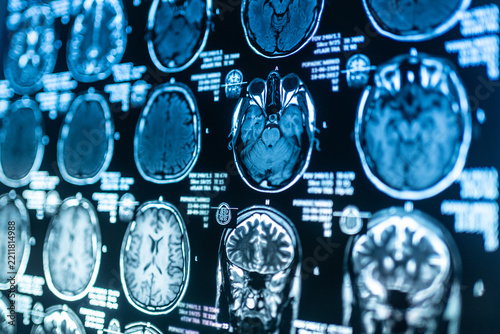Close-up view of magnetic resonance imaging scans of of the human brain