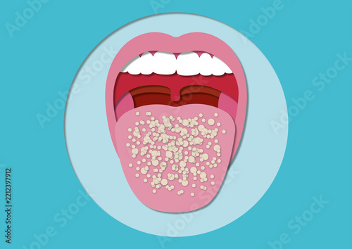 Oral thrush, illustration