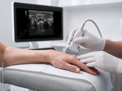 Musculoskeletal Ultrasound Showing Rheumatoid Arthritis Synovitis in Hand Joint