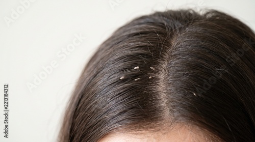 Head lice infestation visible on dark human hair strands close up