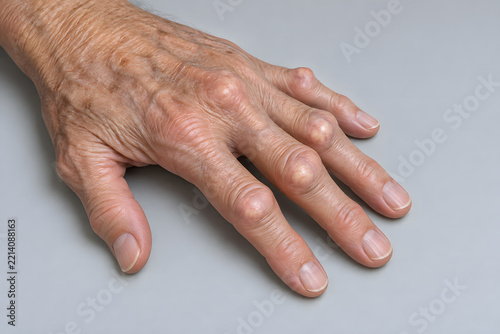 Older hand with pale joint nodules illustrating tophaceous gout