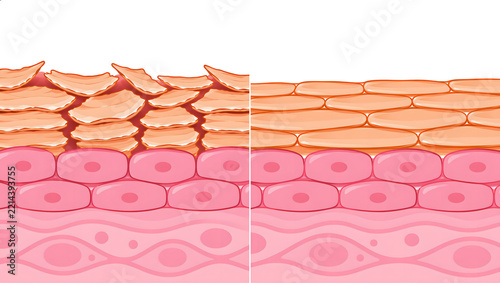 Damaged vs healthy skin barrier comparison with dry flaky and smooth hydrated skin