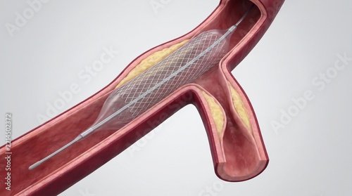 Coronary Bifurcation Stent Deployment with Balloon Catheter