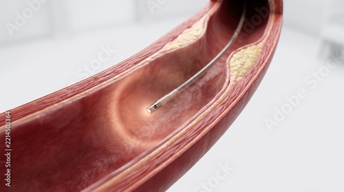 Optical Coherence Tomography Catheter in Coronary Artery