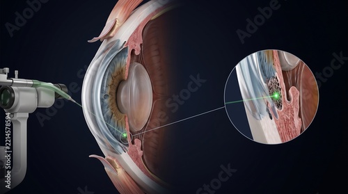Medical illustration of a laser eye surgery procedure, showing a cross-section of the human eye with a laser targeting the trabecular meshwork for treatment.