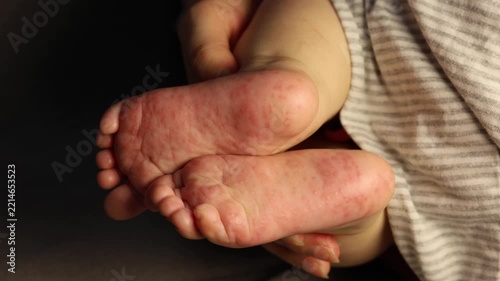 Close up footage of baby feet affected by hand, foot and mouth disease rash or viral enterovirus infection. Coxsackievirus.