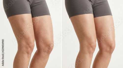 Woman's Thighs Before and After Cellulite Treatment Comparison