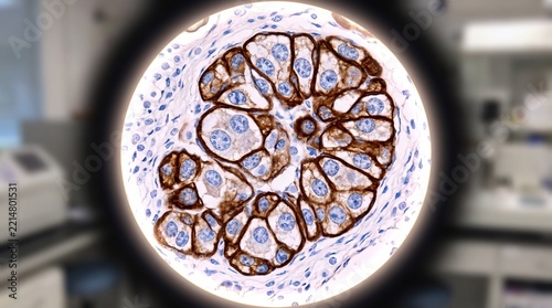 Microscopic view of HER2-positive breast cancer cells showing strong membrane receptor expression detected through immunohistochemical staining in a pathology laboratory.