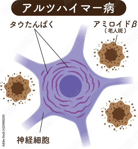 アルツハイマー病の脳　アミロイドβとタウたんぱく質　The Alzheimer's Brain: Amyloid-beta and Tau Protein