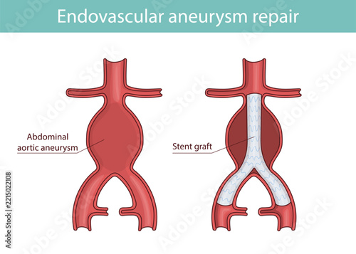 Illustration of aortic aneurysm after stent-graft intervention.