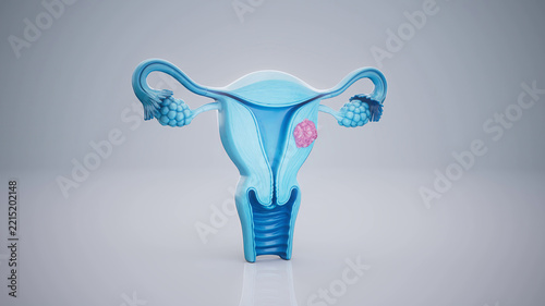 Conceptual 3D illustration of a uterine fibroid and uterine anatomy