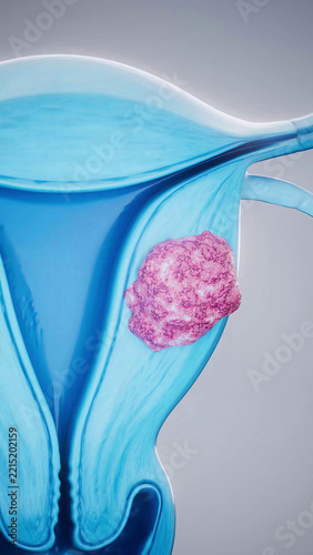 Conceptual 3D illustration of a uterine fibroid and uterine anatomy