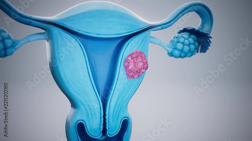 Conceptual 3D illustration of a uterine fibroid and uterine anatomy