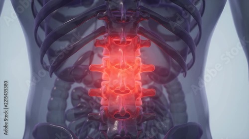 Human Lumbar Spine Inflammation Medical Animation Showing Painful Vertebrae