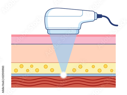 HIFU High Intensity Focused Ultrasound Skin Lifting Treatment Diagram Showing Waves Penetrating Tissue Layers for Non-Surgical Facelift