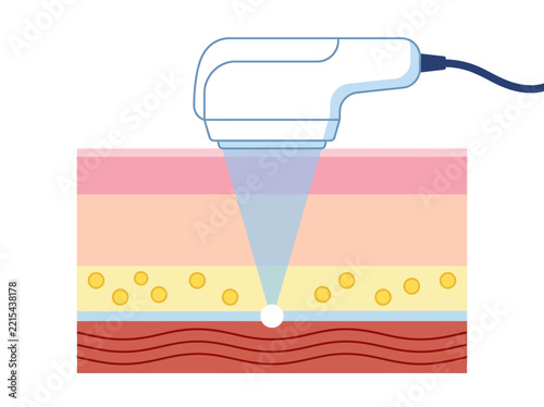 HIFU High-Intensity Focused Ultrasound Skin Treatment Diagram - Non-Invasive Skin Tightening and Lifting Technology Cross-Section Illustration