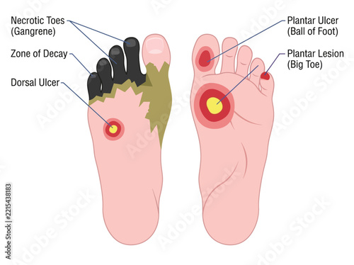 Medical Illustration of Diabetic Foot Complications Showing Necrosis, Gangrene, Plantar Ulcers and Dorsal Lesions