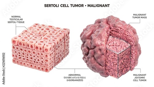 Malignant Sertoli cell tumor comparative medical illustration, normal testicular Sertoli tissue vs disorganized malignant tumor mass