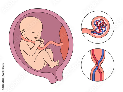 Fetus in Womb with Umbilical Cord Complications: Nuchal Cord and True Knot Illustration