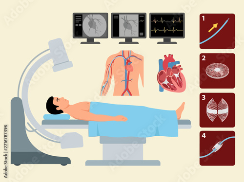 Cardiac Catheterization and Heart Stent Procedure Medical Illustration with Patient, Monitoring Equipment, and Surgical Steps