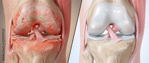 Medical Comparison Showing Anatomy of Osteoarthritis versus Healthy Human Knee Joint Cartilage