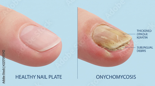 Healthy Nail vs Onychomycosis Fungal Infection 3D