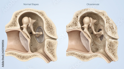 Normal Stapes vs Otosclerosis Ear Anatomy 3D