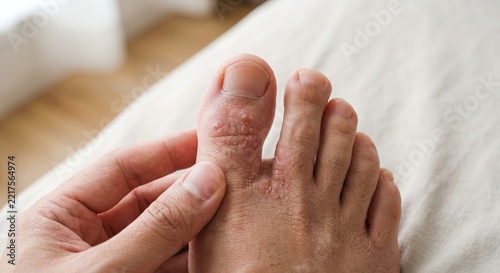 Patient hands inspecting a big toe afflicted with severe athlete foot fungus or dyshidrotic eczema peeling skin