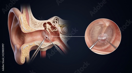 Detailed illustration of an ear examination or procedure with medical instruments.