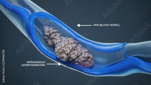 Intravenous Leiomyosarcoma 3D medical illustration, malignant tumor growing inside human vein blood vessel