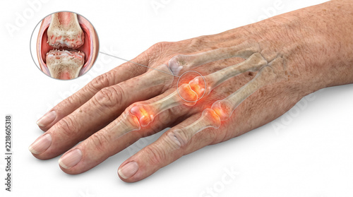 Hand arthritis 3D medical illustration. Elderly hand with transparent skin showing swollen inflamed finger joints and magnified knuckle cartilage damage on white