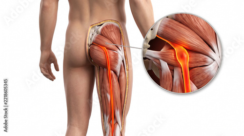 Sciatica 3D medical illustration. Back of human leg with skin cutaway showing glowing sciatic nerve running through gluteal muscle and zoomed compression on white