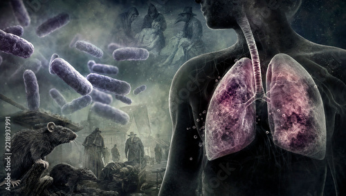 Pneumonic plague infection.