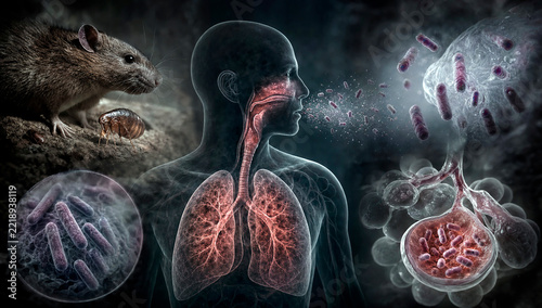 Pneumonic plague infection.
