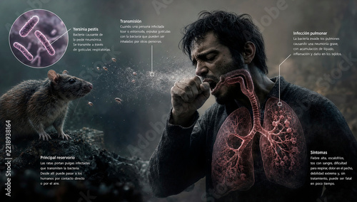 Pneumonic plague infection.