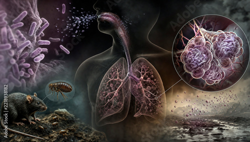 Pneumonic plague infection.