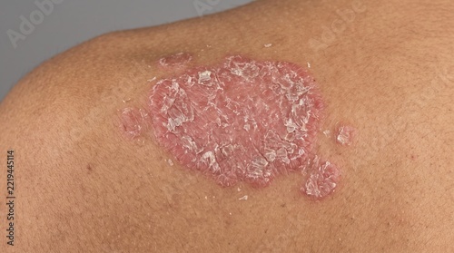 Detailed view of a typical psoriasis plaque with silvery scales on skin