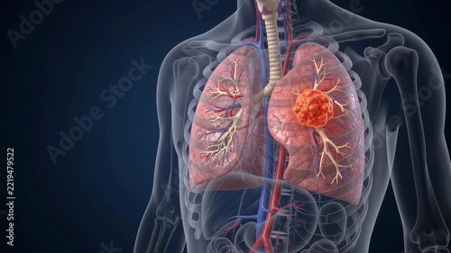 Lung cancer anatomy illustration showing respiratory system tumor growth inside lung organ highlighting medical health disease concept for education diagnosis and awareness study