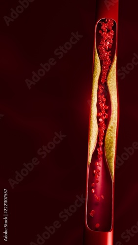 Cholesterol Buildup Narrowing Artery with Red Blood Cells Showing Poor Blood Circulation and Risk of Heart and Blood Vessel Disease 3D Rendering